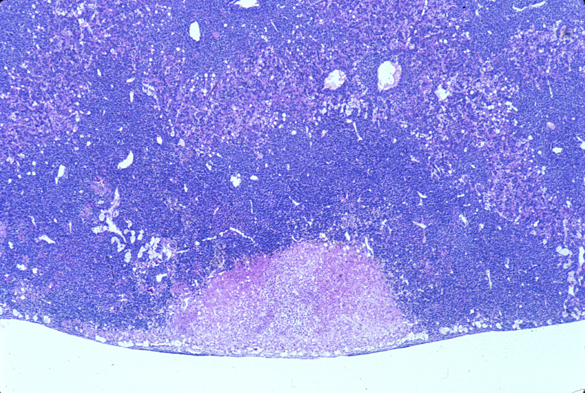 Histiocytic sarcoma in the liver with accompanying necrosis.